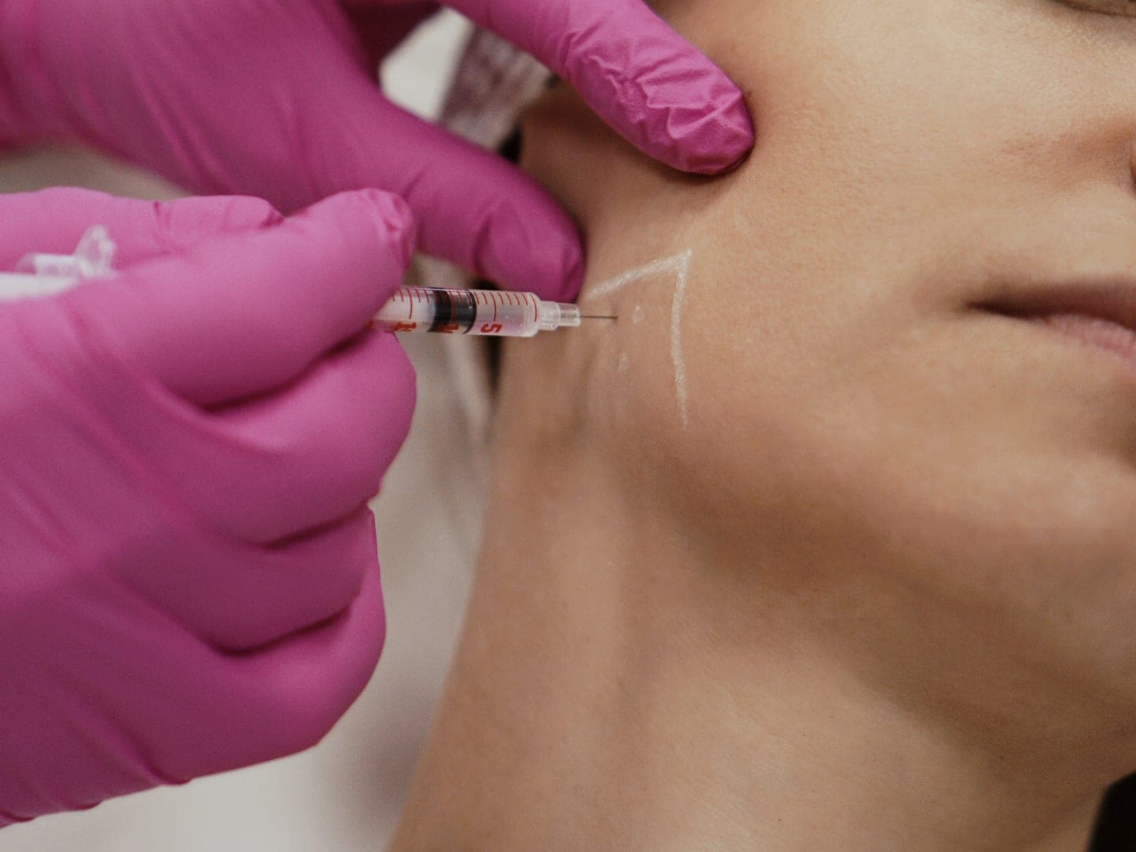 Podanie toksyny botulinowej w mięsień żwacz przy leczeniu bruksizmu — Kliniki Dr Kuschill MEDESTETIS