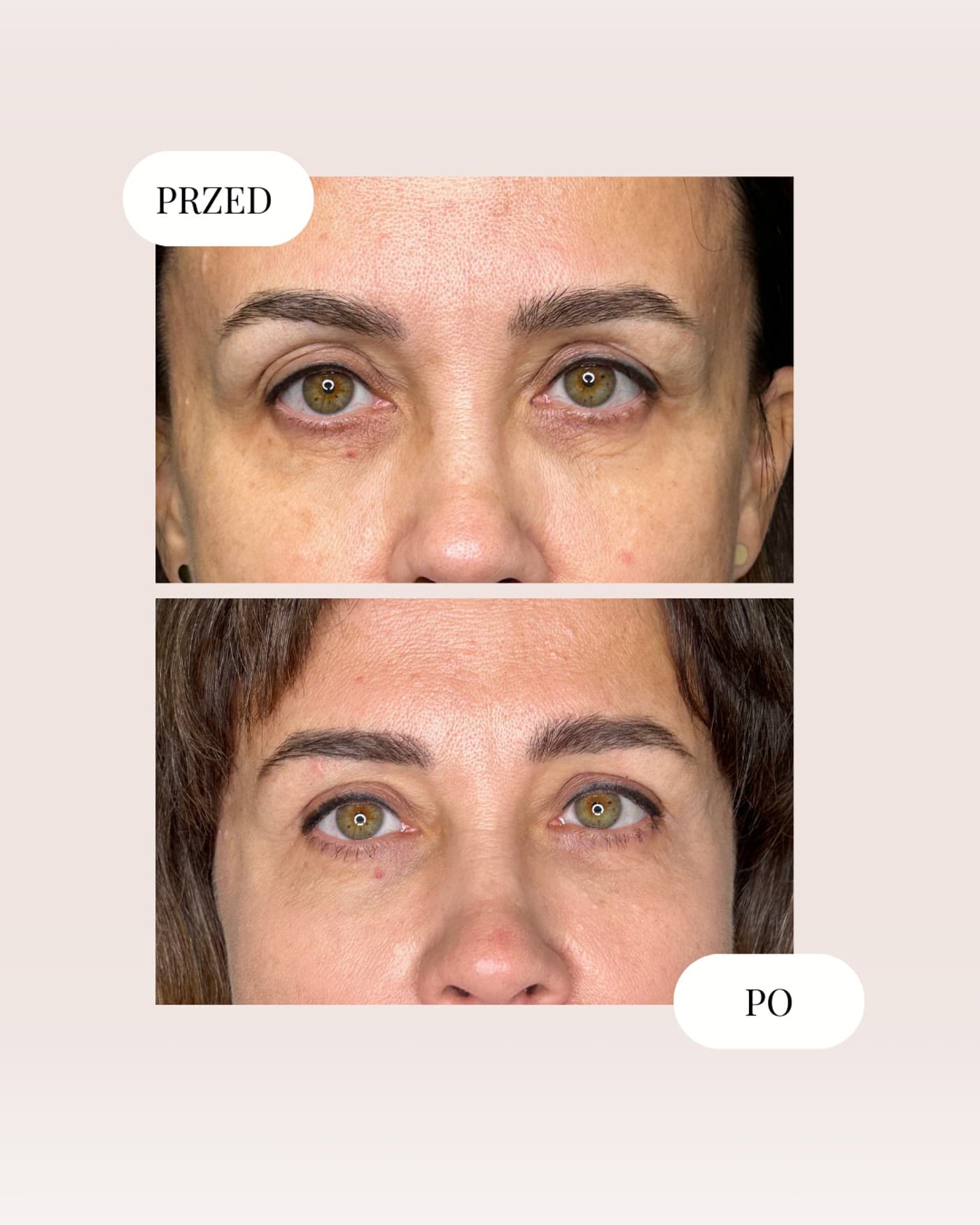 Plastyka powiek górnych — efekt przed i po, Kliniki Dr Kuschill MEDESTETIS