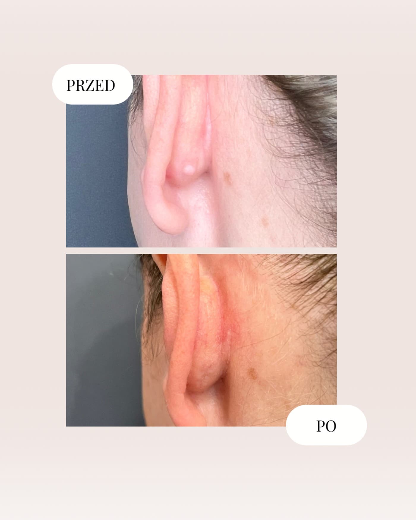 Chirurgiczne usunięcie zmiany skórnej — efekt przed i po, Kliniki Dr Kuschill MEDESTETIS