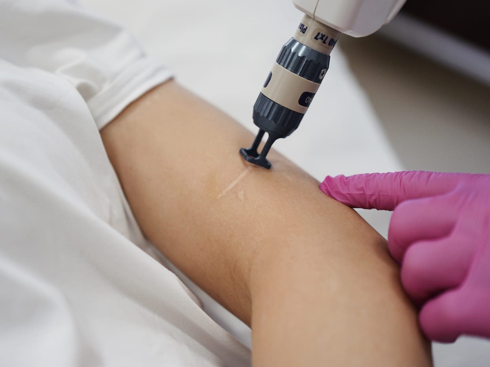 Głowica lasera frakcyjnego prowadzona po skórze ramienia podczas zabiegu na bliznę — Kliniki Dr Kuschill MEDESTETIS