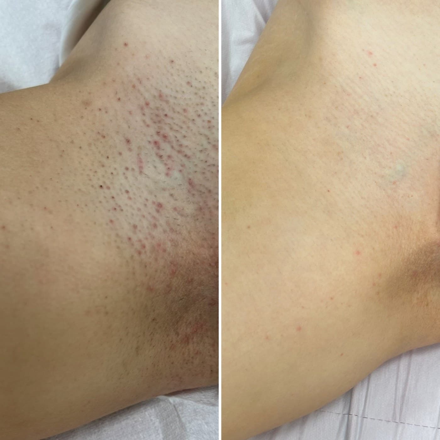 Depilacja laserowa — efekt po serii — efekt przed i po, Kliniki Dr Kuschill MEDESTETIS
