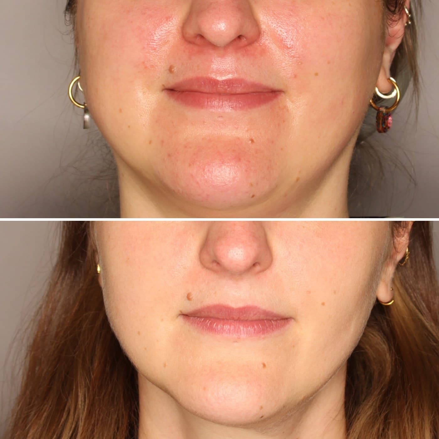 Leczenie dermatologiczne i pielęgnacja — efekt przed i po, Kliniki Dr Kuschill MEDESTETIS