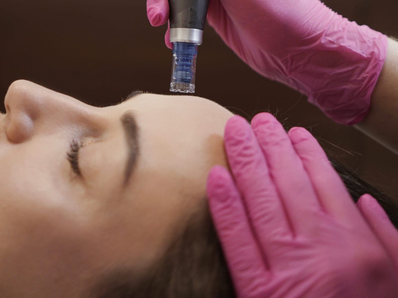 Mikronakłuwanie skóry twarzy urządzeniem Dermapen 4 — Kliniki Dr Kuschill MEDESTETIS
