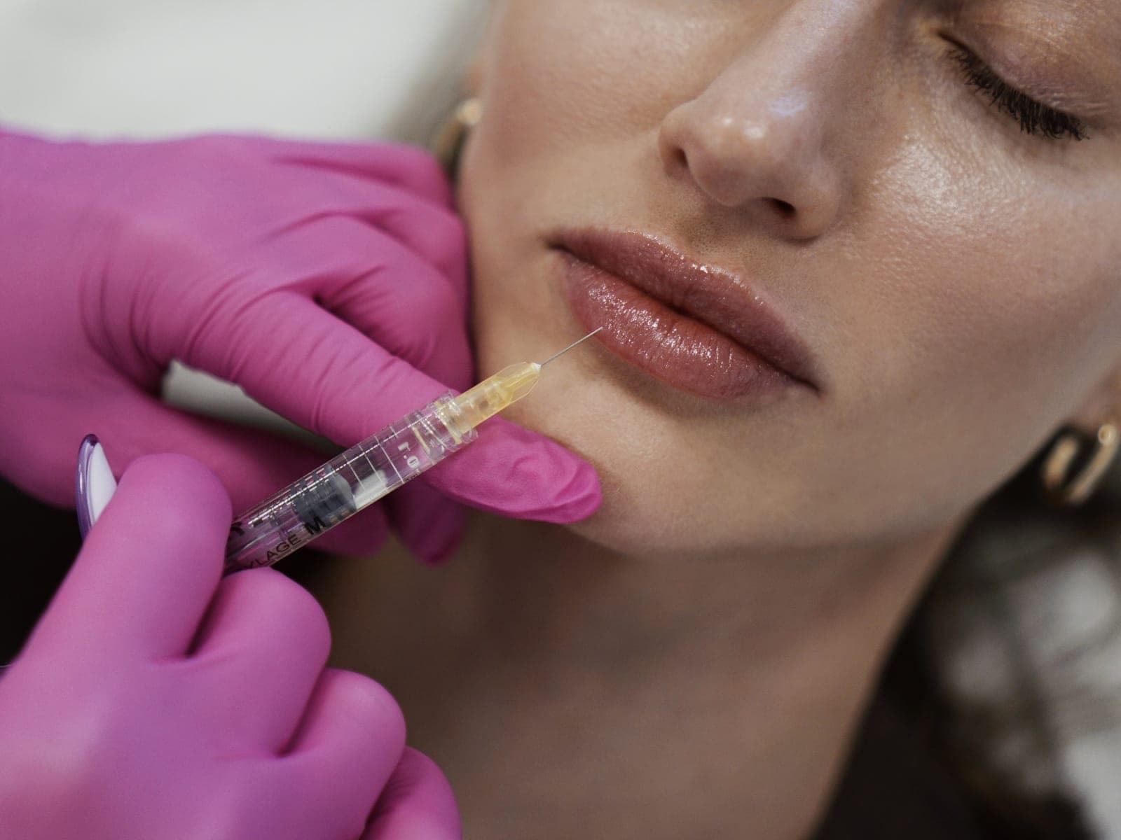 Podanie kwasu hialuronowego w usta cienką igłą podczas modelowania ust — Kliniki Dr Kuschill MEDESTETIS