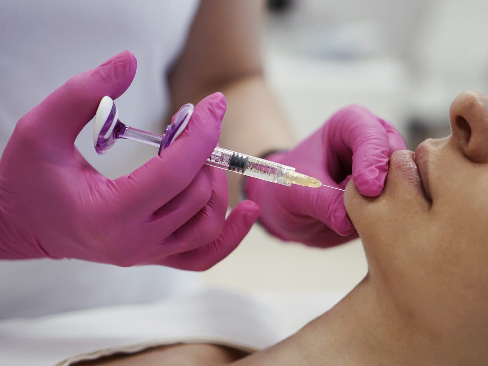 Wypełnianie okolicy ust kwasem hialuronowym u pacjentki leżącej na fotelu zabiegowym — Kliniki Dr Kuschill MEDESTETIS