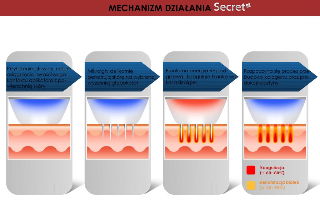 Radiofrekwencja mikroigłowa Secret RF mechanizm działania