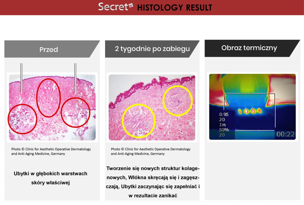 Radiofrekwencja mikroigłowa Secret RF rezultaty