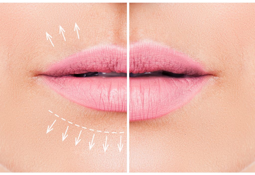 Piękne różowe usta przed i po wstrzyknięciu wypełniacza kolagenowego